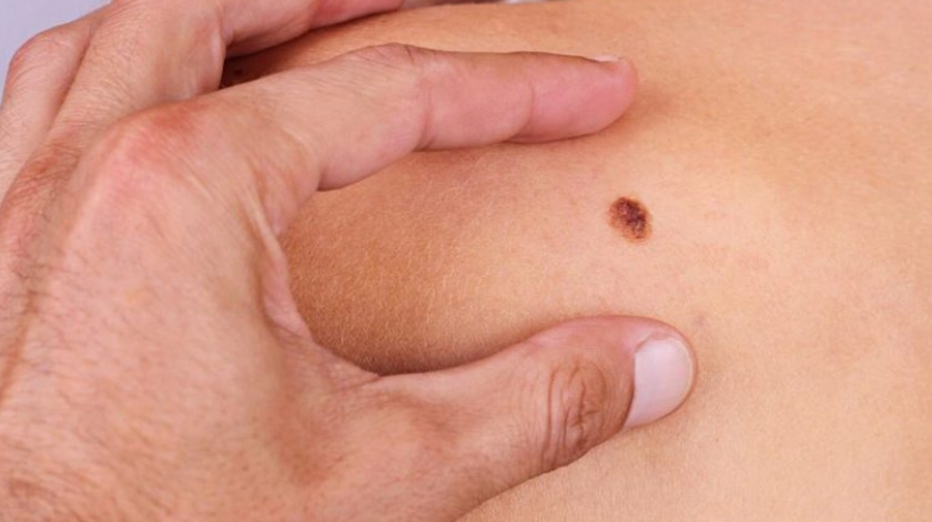 Aprenda a identificar cancro de pele
